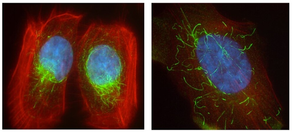 Cellule cancéreuse de glioblastome. En présence de PARP3, à gauche, un réseau de microtubules structurés. A droite, en l'absence de PARP3, un réseau instable. Crédit DR