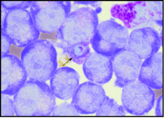 Érythroblaste Duffy négatif (à J9 de la différenciation des progéniteurs érythroïdes) infectés par un isolat malgache de P. vivax observés en microscopie optique (stade mature). © Isabelle Bouyssou & Didier Menard