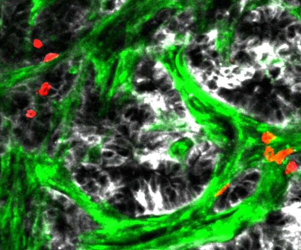 En ciblant la matrice tumorale avec le peptide Maremo, les cellules T cytotoxiques (rouge) s'infiltrent dans la tumeur, provoquant la mort cellulaire et une réduction de la croissance tumorale. (Vert, stroma. Cellules tumorales blanches.) ©Irena Rajnpreht